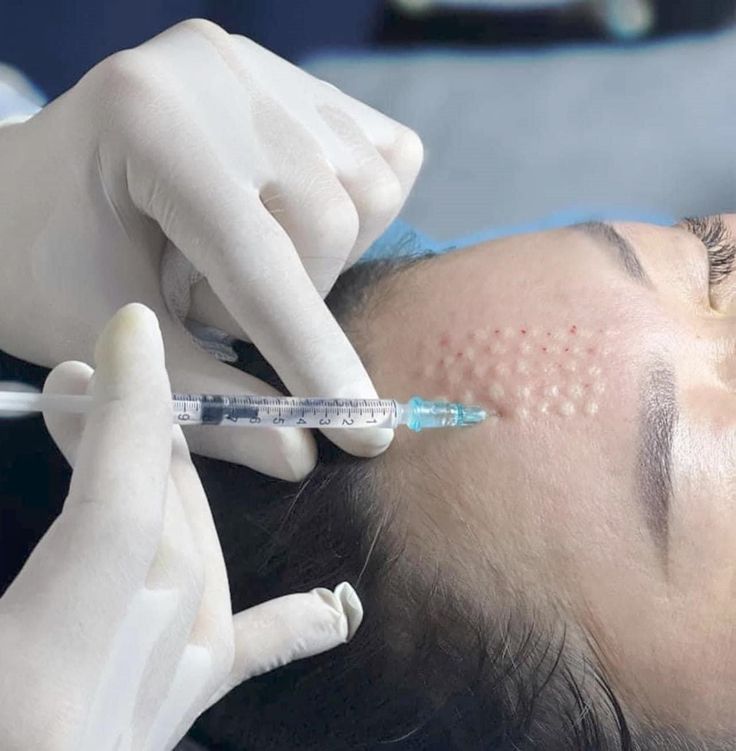 mesotherapy và tiêm meso – 5 lưu ý quan trọng trước khi quyết định thực hiện