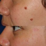 mole & growth removal small skin imperfections…