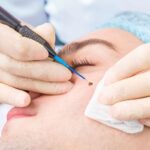 radiofrequency mole removal raised moles