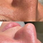 remove blackheads