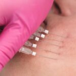 what are thread lifts here's everything you should know